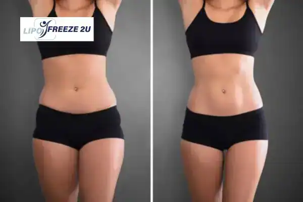 How Can LIPO FREEZE 2U Support Your Post-Pregnancy Body Recovery South Yorkshire?