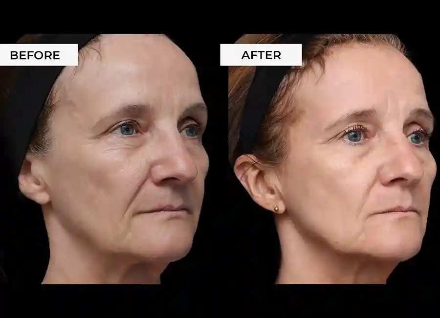 How Many RF Microneedling Sessions Will You Need to See a Difference South Yorkshire?
