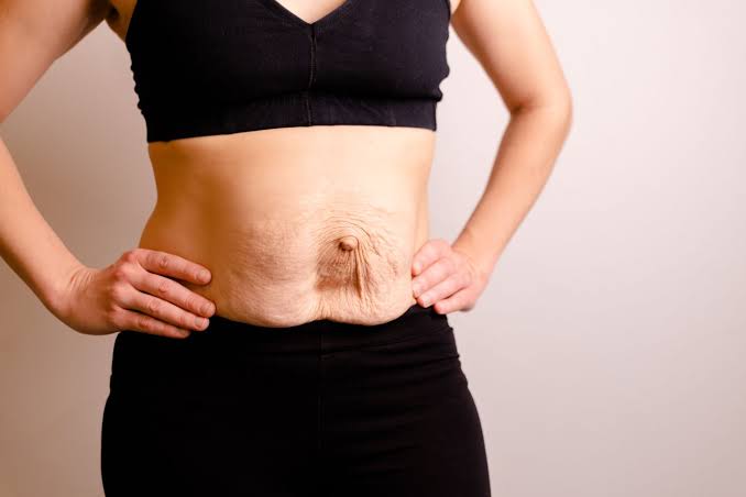 Is Surgery Really the Only Way to Repair Diastasis Recti South Yorkshire?