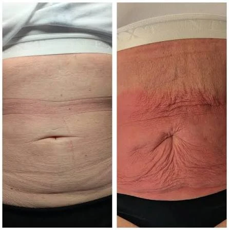 How Does RF Microneedling Improve Crepey, Thin and Uneven Skin Texture South Yorkshire?