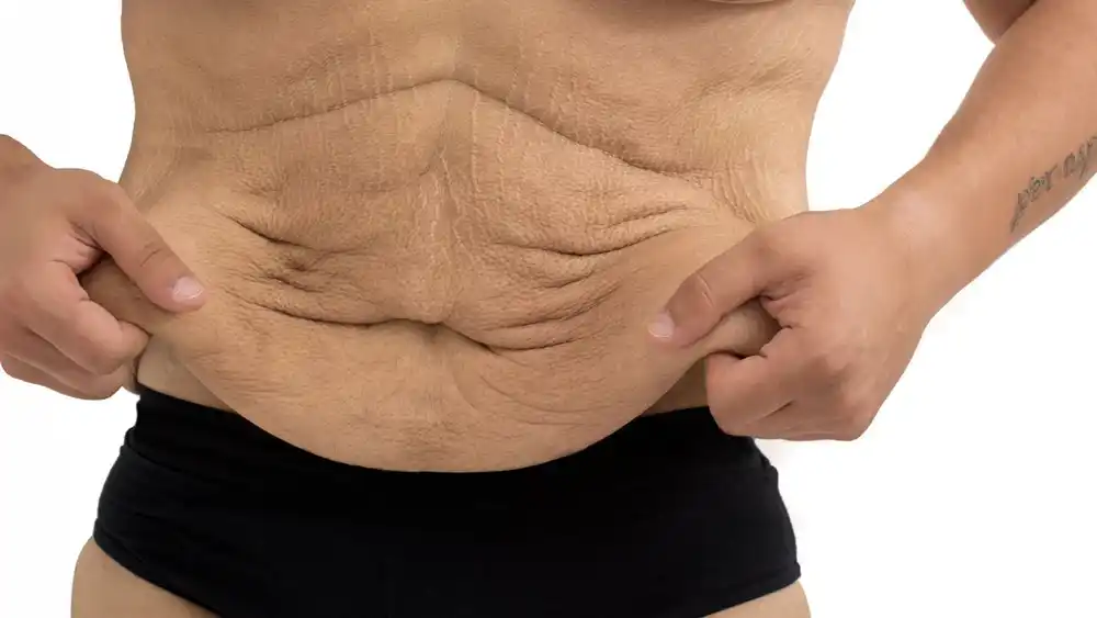 RF Microneedling for Loose Skin: How Can It Help Tighten and Reshape the Skin South Yorkshire?